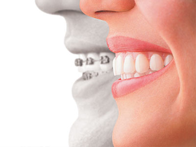 Granger Dentistry | All-on-4 reg , Ceramic Crowns and Juvederm reg 
