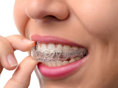 Granger Dentistry | Preventative Program, Dental Fillings and Oral Cancer Screening