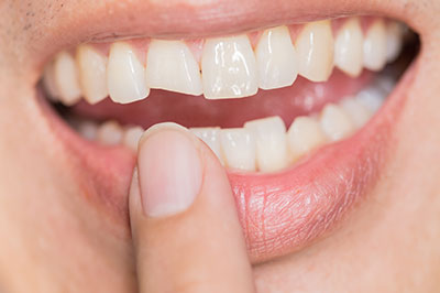Granger Dentistry | Dental Cleanings, All-on-6 reg  and ZOOM  Whitening