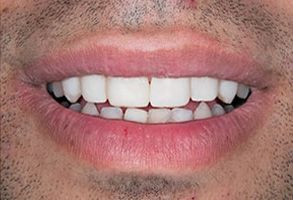 Granger Dentistry | Implant Dentistry, Dental Bridges and Veneers